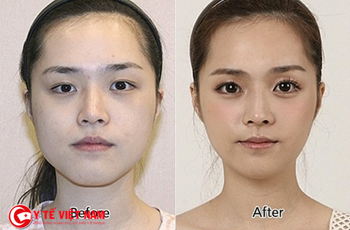 Sau khi sử dụng phương pháp cắt mí mắt Hàn Quốc bạn sẽ “trẻ mái với thời gian”
