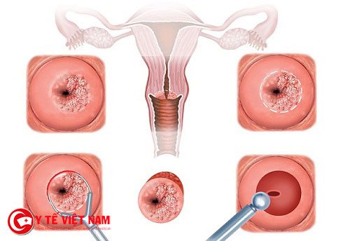 Viêm lộ tuyến cổ tử cung là bệnh lý được nhắc đến nhiều khi nói đến các bệnh viêm phụ khoa ở chị em phụ nữ.