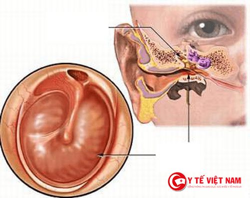 Viêm tai giữa sung huyết làm cho màng tai hồng hơn
