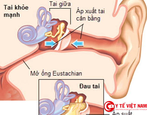 Viêm tai giữa ứ dịch có thể do rối loạn chức nằng vòi nhĩ 