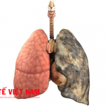 Ung thư phổi có mổ được không