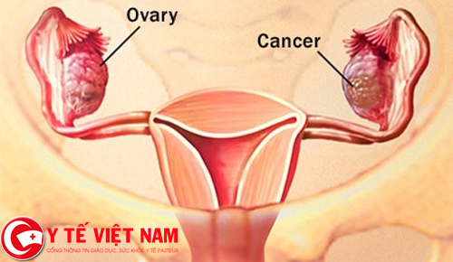 Bệnh ung thư buồng trứng thường xuất hiện ở người phụ nữ