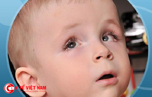 Bệnh võng mạc ở trẻ sinh non có nguy cơ gây mù vĩnh viễn