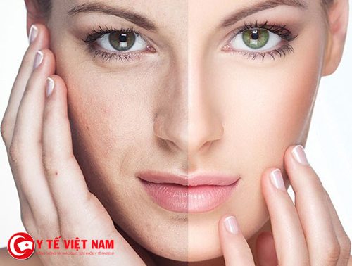 Căng da mặt duy trì kết quả lâu dài và an toàn tuyệt đối Căng da mặt duy trì kết quả lâu dài và an toàn tuyệt đối