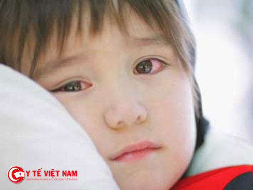 Bé sẽ thấy cộm mắt hoặc sưng mắt khi bị đau mắt đỏ