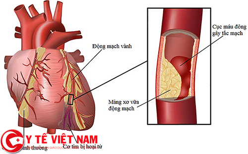 Hình ảnh bệnh động mạch vành