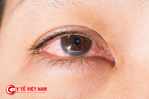 Đau mắt đỏ ở trẻ em có rất nhiều biến chứng