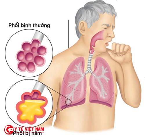Phương pháp điều trị bệnh nấm phổi tùy thuộc vào giai đoạn bệnh