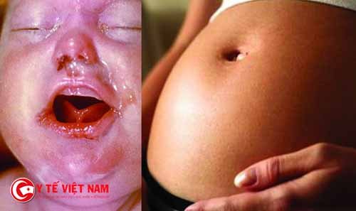 Bệnh giang mai bẩm sinh gây ảnh hưởng nguy hiểm tới thai nhi