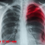 Bệnh tràn dịch màng phổi nguy hiểm