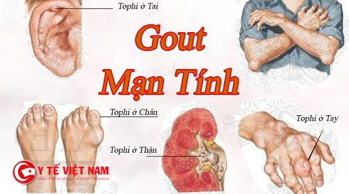 Bệnh gout mạn tính là một trong những biến chứng của bệnh gout