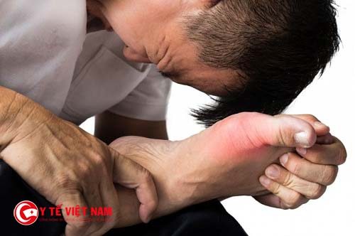 Bệnh gout đa số thường gặp ở nam giới từ 33 đến 55