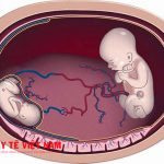 Hiện tượng đa ối khi mang thai có thể gây dị tật cho thai nhi