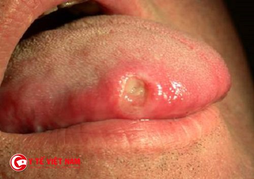 Các vết trợt bắt đầu xuất hiện ở miệng khi bệnh chuyển sang giai đoạn 2