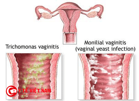 Nấm âm đạo là bệnh lý viêm nhiễm cơ quan sinh dục nữ