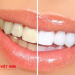Tại sao răng lại có màu trắng đục
