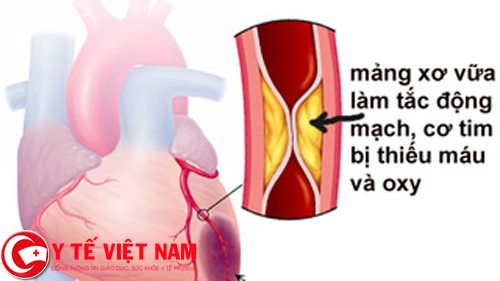 Bệnh thiếu máu cơ tim là gì?