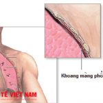 Bệnh viêm màng phổi là gì?