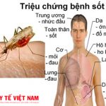 Triệu chứng của bệnh sốt rét