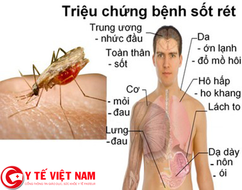 Triệu chứng của bệnh sốt rét