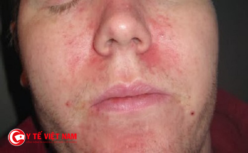 Bệnh viêm da dị ứng mặt là căn bệnh mạn tính ngoài da