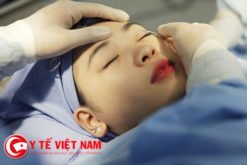 Những lưu ý sau phẫu thuật cắt mí mắt Hàn Quốc