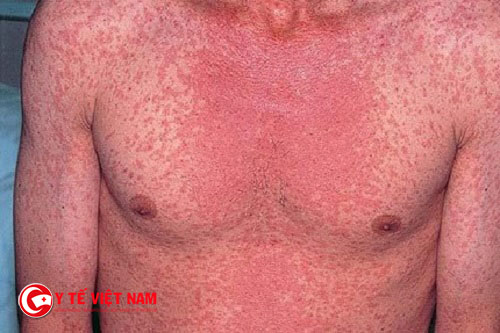 Đỏ da toàn thân là một trong những biểu hiện của dị ứng thuốc