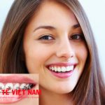 Niềng răng là giải pháp tối ưu nhất trong khi thẩm mỹ răng cửa thưa