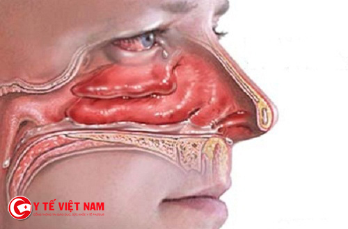 Bệnh viêm mũi dị ứng nếu không điều trị kịp thời sẽ trở thành bội nhiễm