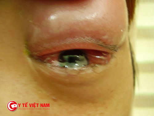 Bệnh viêm da dị ứng mặt gây nhiều biến chứng về mắt