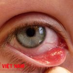 Viêm kết mạc mắt là biểu hiện của bệnh sốt siêu vi