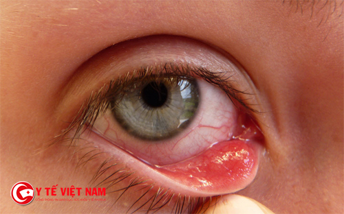 Viêm kết mạc dị ứng là một trong những triệu chứng của dị ứng sưng mắt