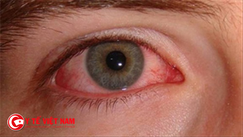 Viêm nhãn cầu nếu không được điều trị sẽ dẫn đến mù lòa