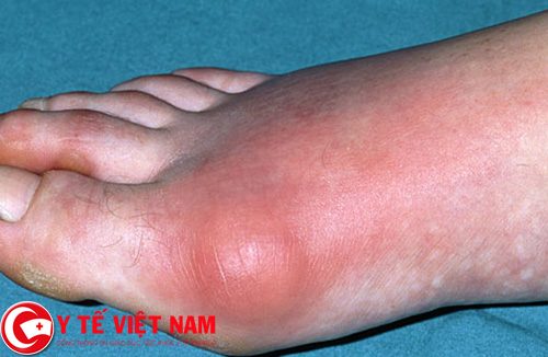 Cao gắm chữa bệnh gút nhanh chóng, hiệu quả trong 7 ngày Cao gắm chữa bệnh gút nhanh chóng, hiệu quả trong 7 ngàyCao gắm chữa bệnh gút nhanh chóng, hiệu quả trong 7 ngày