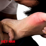 Bệnh gút nguy hiểm