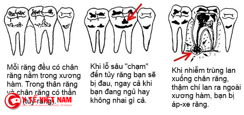Bệnh sâu răng nếu không điều trị kịp thời sẽ gây nhiều nguy hiểm