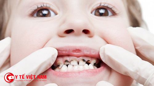Bệnh sâu răng gây ảnh hưởng đến sức khỏe và tính thẩm mỹ của hàm răng