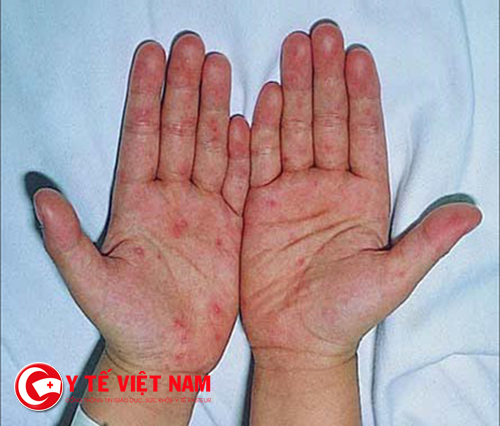 benh_chan_tay_mieng_1