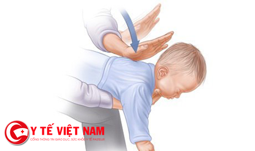 Sơ cứu khi trẻ bị hóc Sơ cứu khi trẻ bị hóc