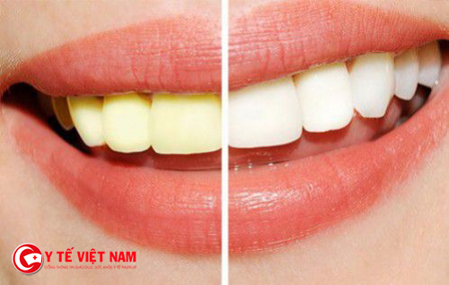 Tẩy trắng răng bằng công nghệ Laser Whitening giúp răng bạn trắng sáng