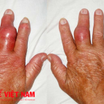 Những sai lầm thường gặp trong điều trị bệnh gút