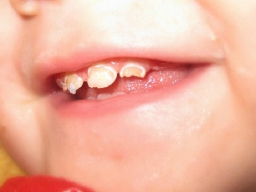 Bệnh sâu răng có nhiều nguyên nhân gây nên và triệu chứng rõ rệt
