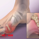 Triệu chứng cảnh báo bệnh gút