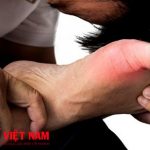 Địa chỉ chữa bệnh gút tại Hải Dương uy tín, chất lượng đảm bảo nhất