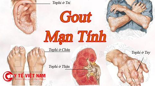 bệnh gút có chữa khỏi hoàn toàn không