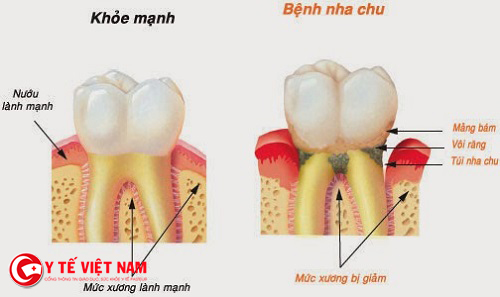 Cao răng gây nên nhiều bệnh nguy hiểm về răng miệng