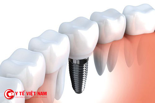 Cấu trúc của răng Implant gồm  3 phần chính