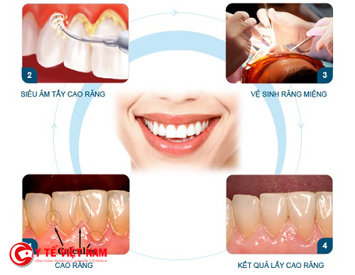 Lấy cao răng thường xuyên có gây ảnh hưởng gì đến răng miệng không?