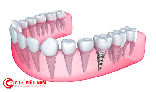 Công nghệ cấy ghép răng Implant được coi là phương pháp hiện đại nhất