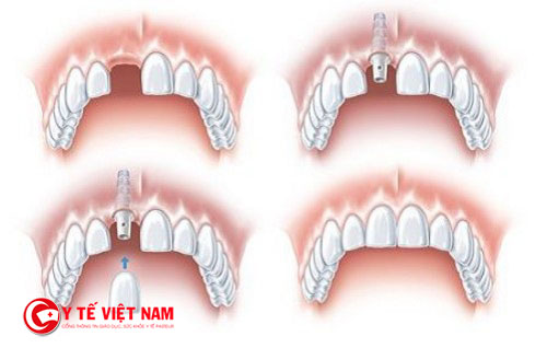 Kỹ thuật cấy ghép Implant mang lại tính thẩm mỹ cao cho hàm răng của bạn